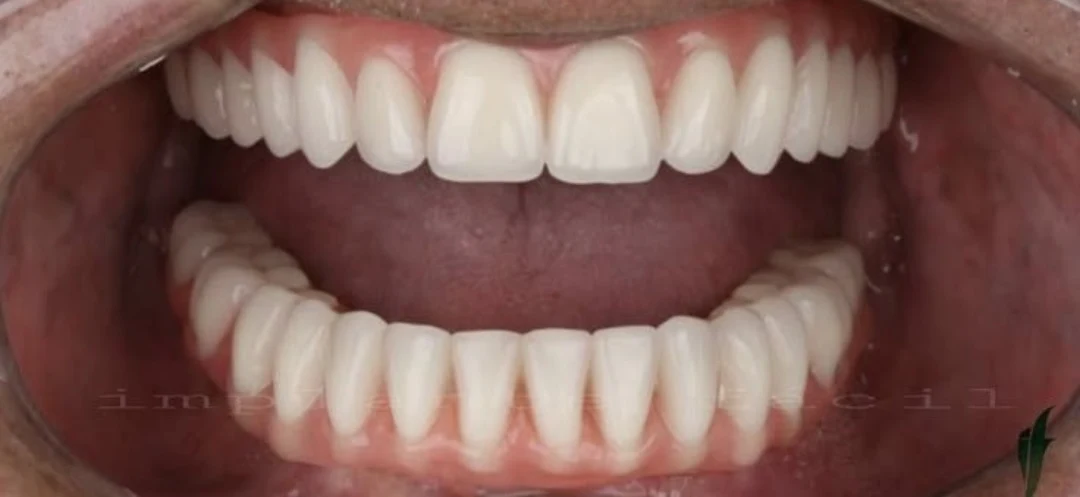 Cas clinique 1 après traitement — implants et prothèses, Kokona Dental, Tirana (cas réel, les résultats individuels varient)