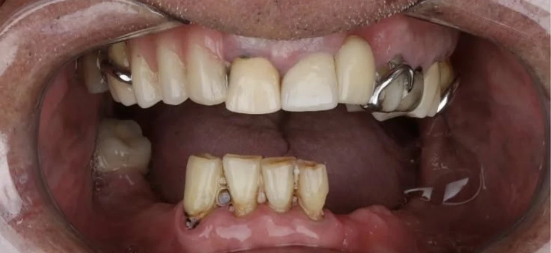 Cas clinique 1 avant traitement — implants et prothèses, Kokona Dental, Tirana (cas réel, les résultats individuels varient)