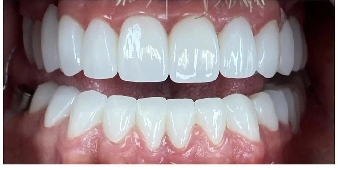 Cas clinique 1 après traitement — implants et prothèses, San Marco Dental, Tirana (cas réel, les résultats individuels varient)