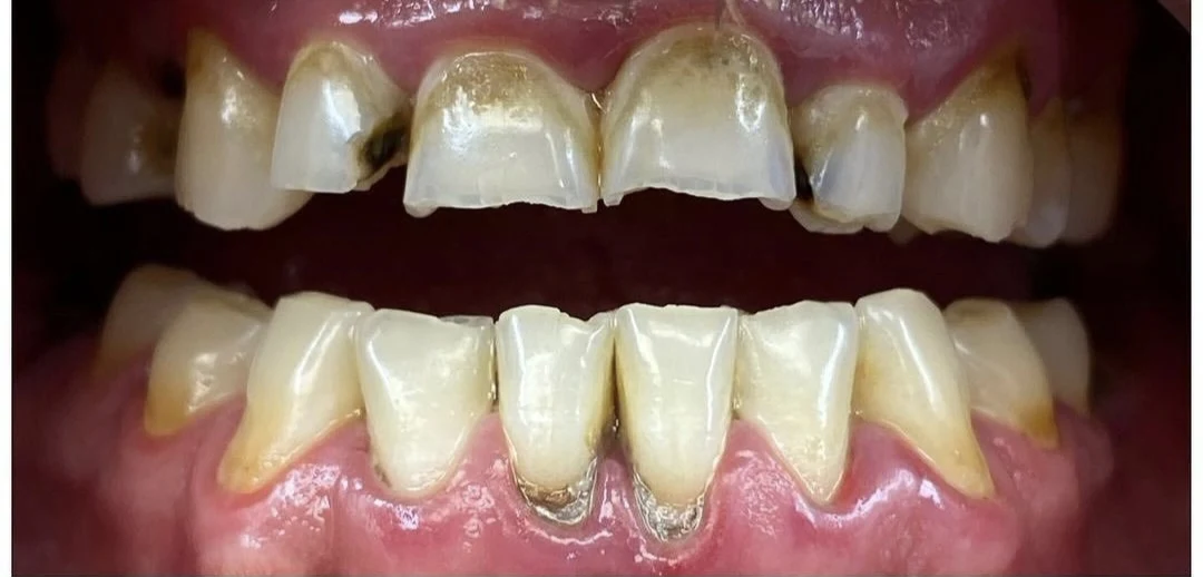 Cas clinique 1 avant traitement — implants et prothèses, San Marco Dental, Tirana (cas réel, les résultats individuels varient)
