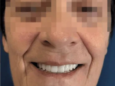 Cas clinique 2 après traitement — implants et prothèses, San Marco Dental, Tirana (cas réel, les résultats individuels varient)