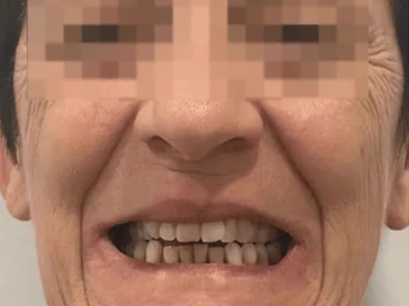 Cas clinique 2 avant traitement — implants et prothèses, San Marco Dental, Tirana (cas réel, les résultats individuels varient)