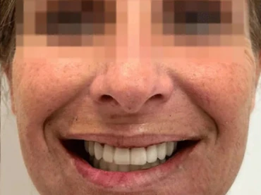 Cas clinique 5 après traitement — implants et prothèses, San Marco Dental, Tirana (cas réel, les résultats individuels varient)