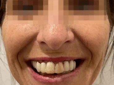 Cas clinique 5 avant traitement — implants et prothèses, San Marco Dental, Tirana (cas réel, les résultats individuels varient)